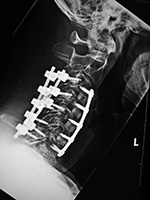 Anterior and cervical spine fusion with intervertebral bone struts